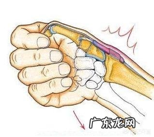 不小心患上腱鞘炎应该如何护理?