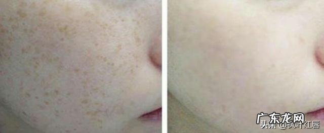 有哪些护肤品可以淡化晒斑?