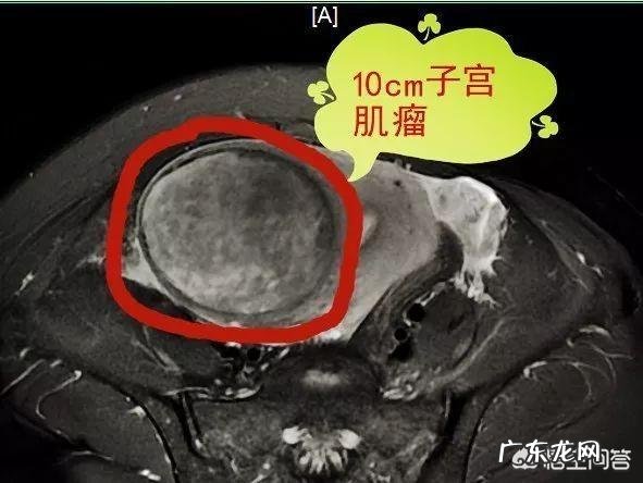子宫肌瘤患者如何应对不良情绪?