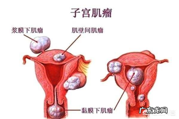 子宫肌瘤患者如何应对不良情绪?