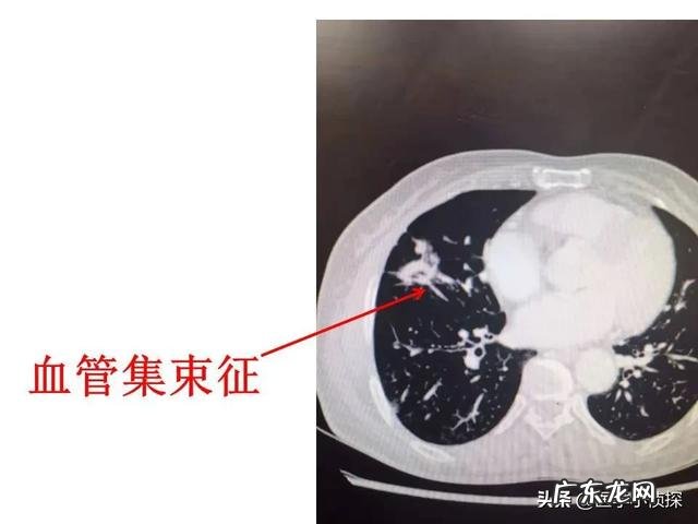 肺结节随访两年无变化,是良性还是恶性是否还要继续随访