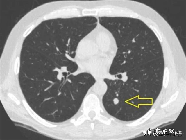 肺结节随访两年无变化,是良性还是恶性是否还要继续随访