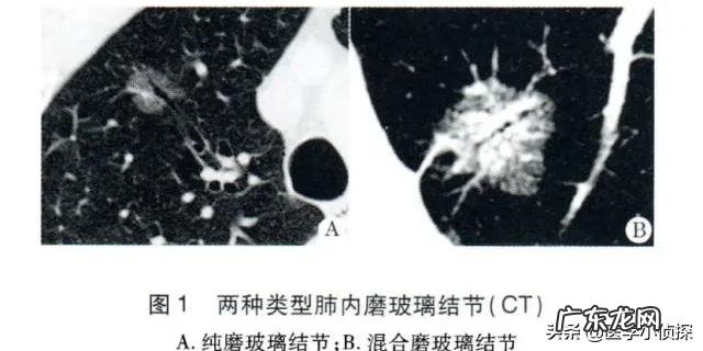 肺结节随访两年无变化,是良性还是恶性是否还要继续随访