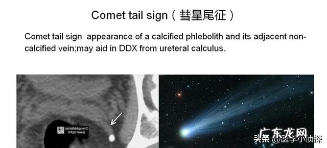 肺结节随访两年无变化,是良性还是恶性是否还要继续随访