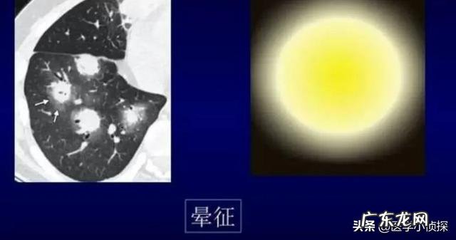 肺结节随访两年无变化,是良性还是恶性是否还要继续随访