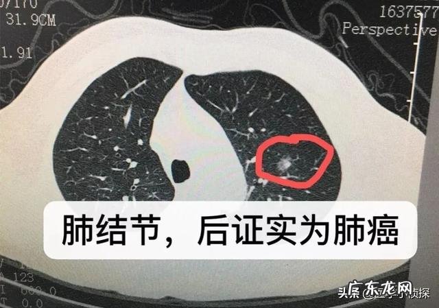 肺结节随访两年无变化,是良性还是恶性是否还要继续随访