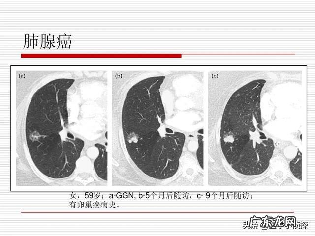 肺结节随访两年无变化,是良性还是恶性是否还要继续随访