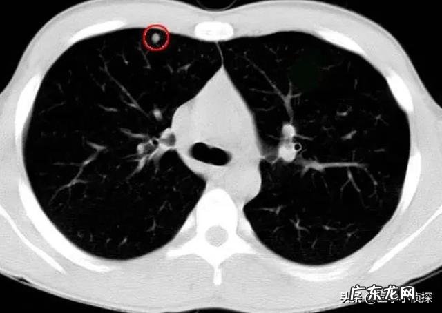 肺结节随访两年无变化,是良性还是恶性是否还要继续随访