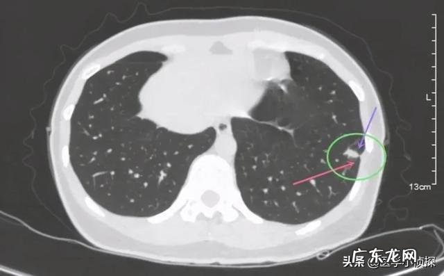 肺结节随访两年无变化,是良性还是恶性是否还要继续随访