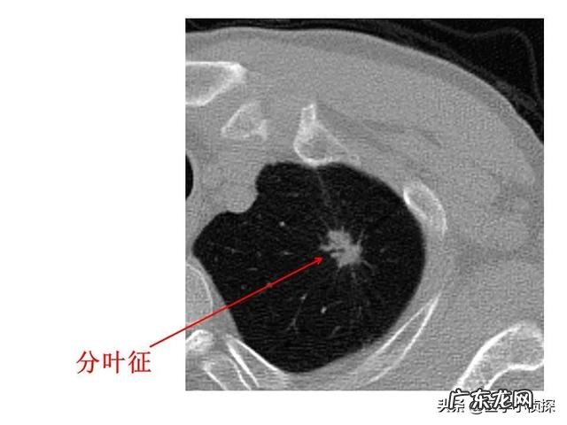 肺结节随访两年无变化,是良性还是恶性是否还要继续随访