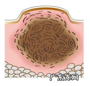 如何快速祛湿、祛痘。在线等!急?