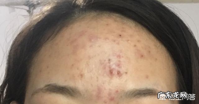 如何快速祛湿、祛痘。在线等！急？