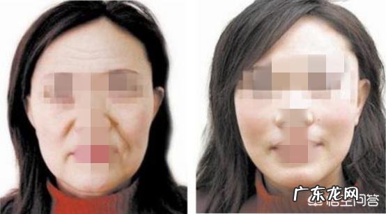 面部肌肤下垂,做提升需要多长时间恢复?能保持多久? 提拉面部紧致肌肤防止下垂