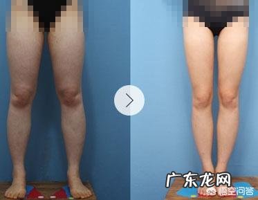 吸脂减肥会让人变得很轻吗?