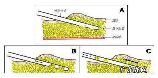吸脂减肥会让人变得很轻吗?