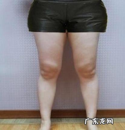 大粗腿可能是湿气太重导致的?