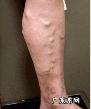 孕期如何缓解静脉曲张和腿脚抽筋?