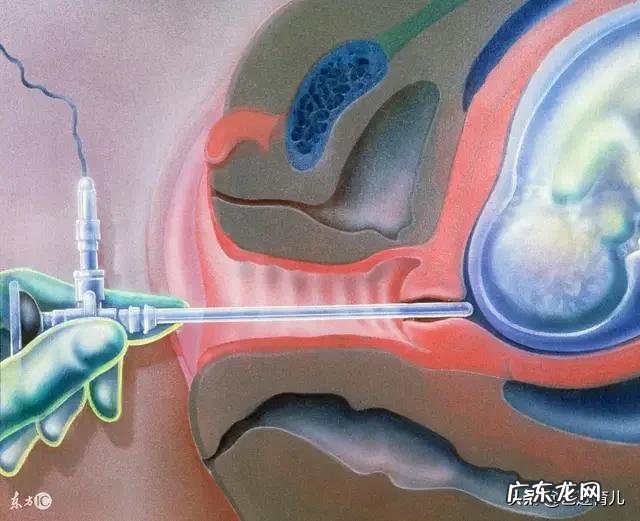 羊水穿刺真的会导致流产吗?为什么?