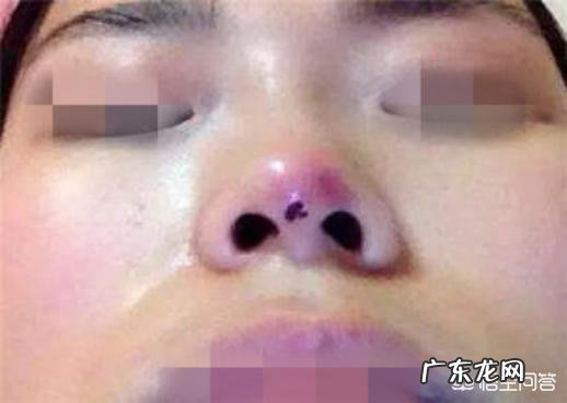 线雕鼻子疼吗?线雕提升一般能维持多久?