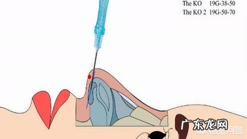 线雕鼻子疼吗?线雕提升一般能维持多久?