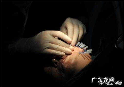 线雕鼻子疼吗?线雕提升一般能维持多久?