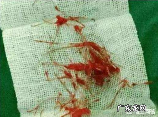 线雕鼻子疼吗?线雕提升一般能维持多久?