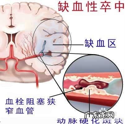 为什么得了脑梗塞,肢体血液循环就会变差