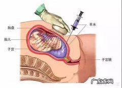 羊水穿刺后三天胎死腹中是医疗事故吗？