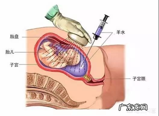 羊水穿刺后三天胎死腹中是医疗事故吗?