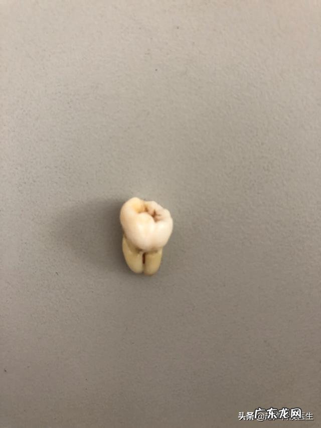 拔牙后的一周你经历了什么？