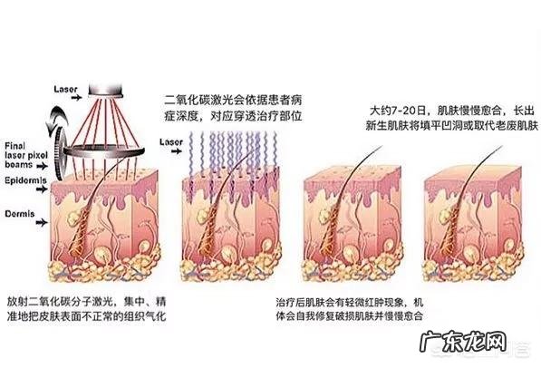 怎么去除眼睛下面的脂肪粒？