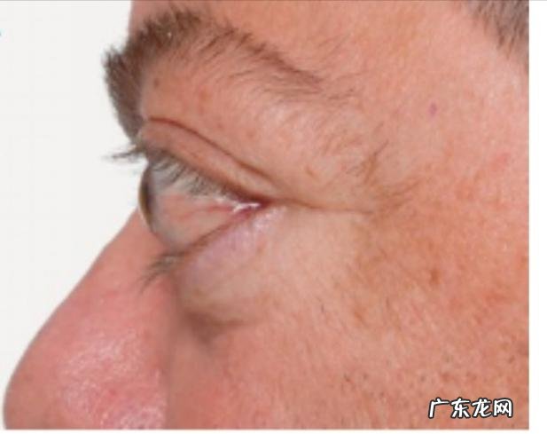 甲亢对生活的影响有哪些?