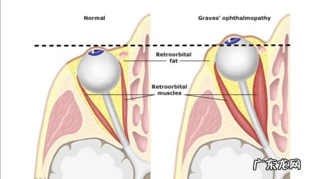 甲亢对生活的影响有哪些?