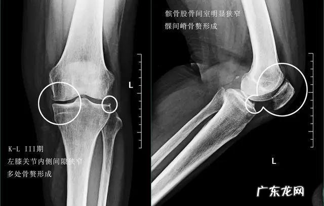 跑步久了膝盖疼怎么回事?