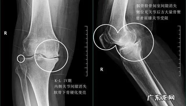 跑步久了膝盖疼怎么回事?