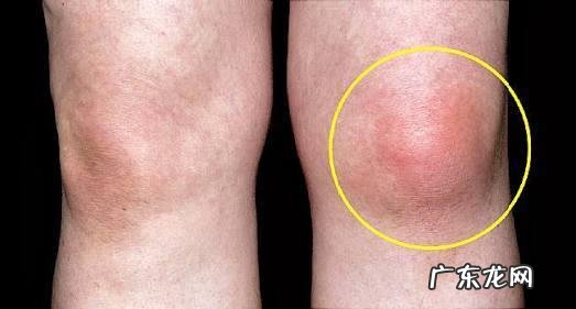 跑步久了膝盖疼怎么回事?