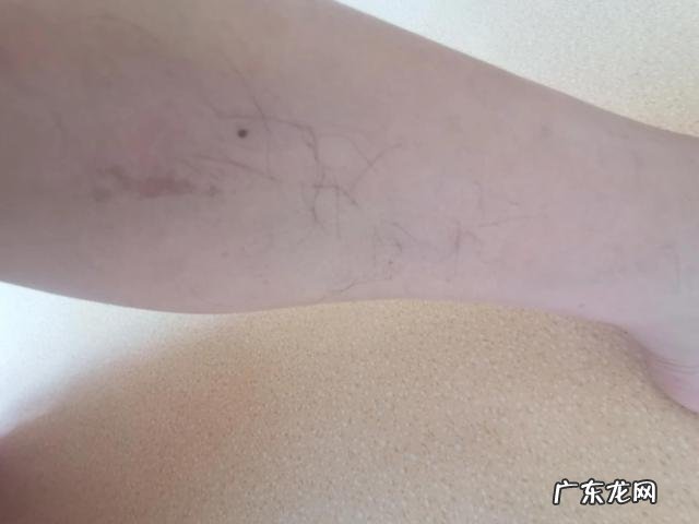 激光去唇毛的价格表 激光脱毛唇毛真的会永久吗