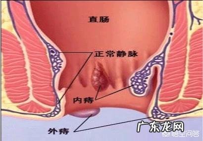 人们常说十人九痔，该怎么预防呢