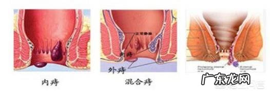 人们常说十人九痔，该怎么预防呢