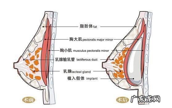 做了假体丰胸手术之后会影响以后给孩子哺乳吗? 胸假体会影响哺乳吗