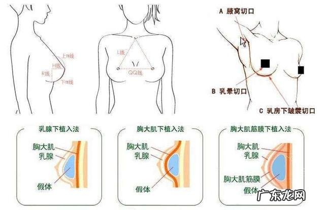 做了假体丰胸手术之后会影响以后给孩子哺乳吗? 胸假体会影响哺乳吗