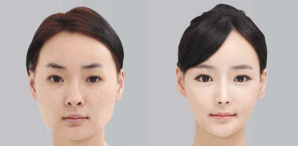 线雕瘦脸可以维持多久?效果怎么样?