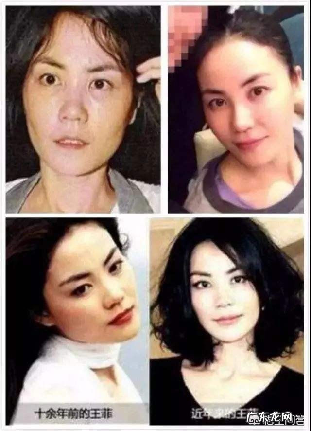 线雕瘦脸可以维持多久?效果怎么样?