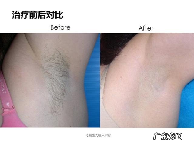 夏天脱毛的最佳时间 夏天到了你准备好脱毛了吗