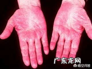 有哪些症状表明要给肝脏排毒了?