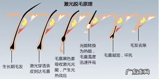 激光脱毛仪能永久脱毛吗 激光永久性脱毛