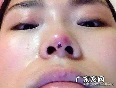 线雕隆鼻的影响,线雕隆鼻有什么危害?