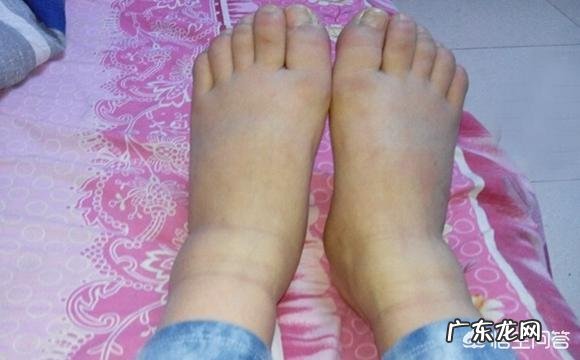 为什么走的时间长了手会肿?