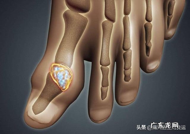 痛风发作期能不能喝冷饮?会加剧疼痛吗?