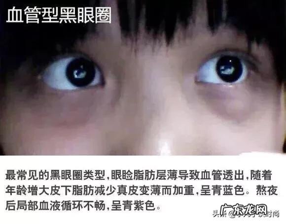 17岁高中生熬夜有眼袋,黑眼圈,泪沟,怎么办